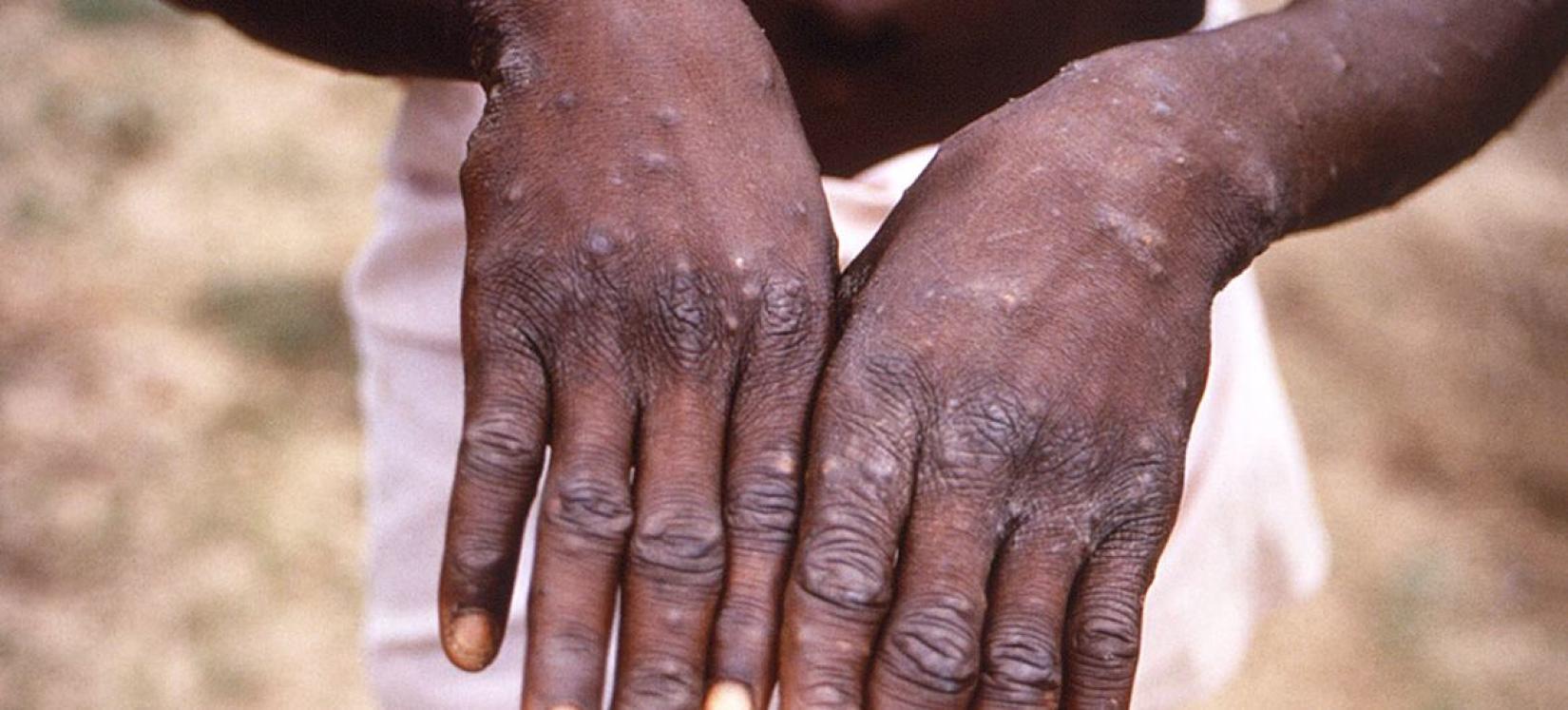 Um jovem mostra as mãos durante um surto de varíola dos macacos na República Democrática do Congo.