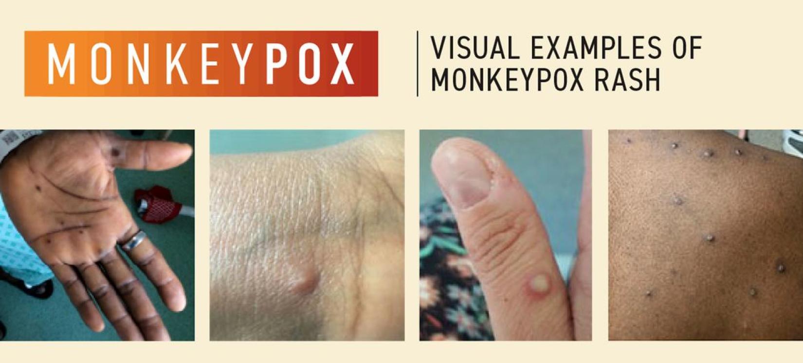 Exemplos de erupções na pele provocadas pelo vírus monkeypox ou varíola dos macacos