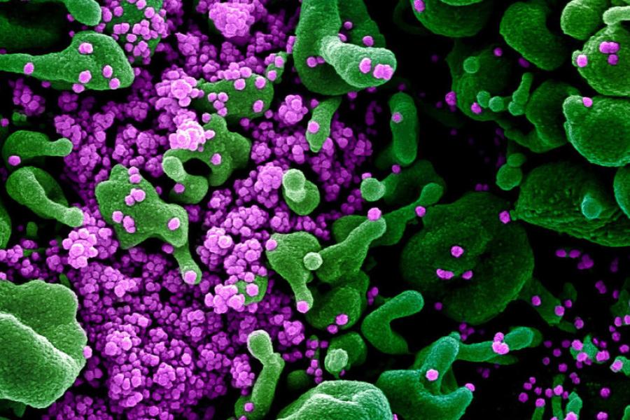 Imagem microscópica mostra células verdes de paciente infectadas pelo vírus da COVID-19, de cor roxa.