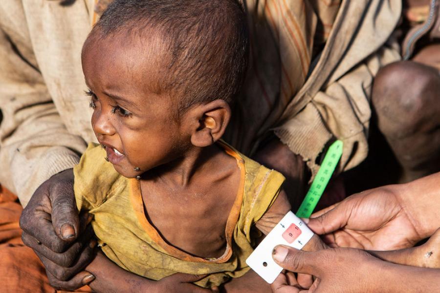 uma criança é atendida pelo Programa Mundial de Alimentos em Madagascar